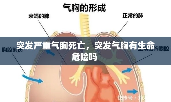 突发严重气胸死亡,突发气胸有生命危险吗