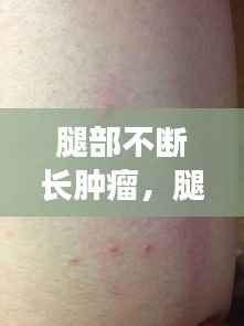 腿部不断长肿瘤,腿上长肿瘤一定是恶性的吗?